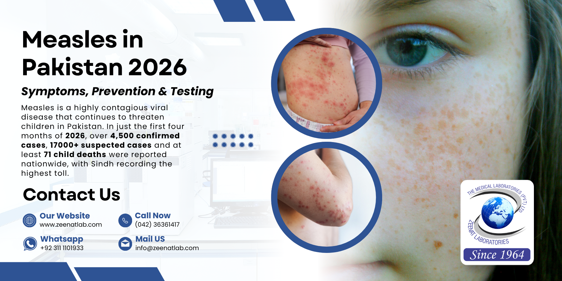Measles in Pakistan 2026 Symptoms, Prevention & Testing